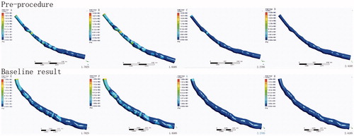 Figure 6. WSS at different moments of isolated and realistically stented coronary artery.