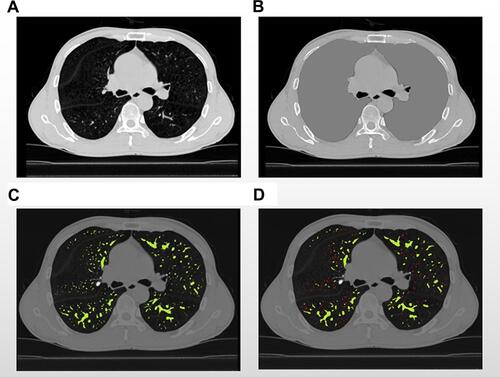 Figure 2 Sample computed tomography (CT) scans used to determine pulmonary small vessels. (A) CT image in middle slice of lung. (B) Segmented lungs shaded in grey. (C) Pulmonary vessels shaded in green. (D) Pulmonary small vessels shaded in red.