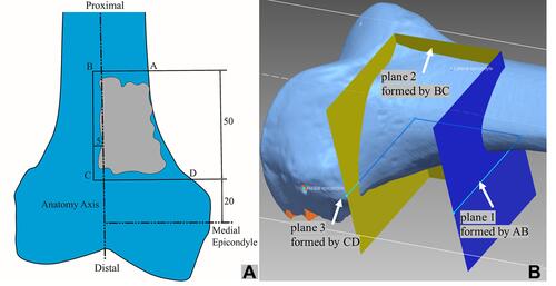 Figure 1 Preoperative plan. (A) A schematic to illustrate a distal femur sarcoma enclosed by line segments AB-BC-CD in the coronal plane. (B) Three target resection planes extended anteriorly and posteriorly from AB-BC-CD that were orthogonal to the coronal plane. These are called Plane 1, 2, and 3, as illustrated.