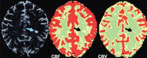 Figure 5. Cerebral blood flow (CBF) and cerebral blood volume (CBV) color-coded maps in MS patient with white matter lesion show perfusion changes in comparison to contralateral normal-appearing white matter (NAWM).