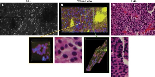 Figure 10 Representative images of a pituitary adenoma rapidly stained ex vivo with AO. (A) Single frame from a Z-stack acquired with a CLE. (B) Volumetric view of the same field of view. The yellow and green rectangular sections of image (B) are enlarged to show greater detail and cellular structures. (C) Circular and linear cell arrangements are shown in the correlative H&E section of the same specimen.Note: Used with permission from Barrow Neurological Institute.Abbreviations: 3D, three-dimensional; AO, acridine orange; CLE, confocal laser endomicroscopy.