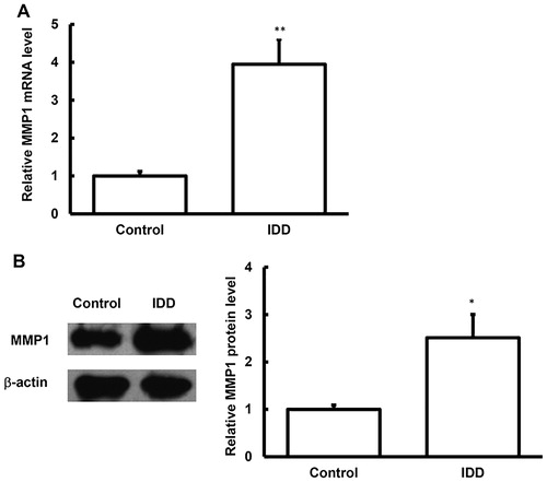 Figure 1. MMP1 expression levels in the nucleus pulposus tissues of IDD.Note: The mRNA (A) and protein (B) expression levels of MMP1 in the nucleus pulposus tissues of IDD patients and normal control subjects were detected with quantitative real-time PCR and Western blot analysis, respectively. Compared with the control group, *p < 0.05, **p < 0.01.