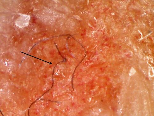 Figure 3 Secondary EM rash revealing embedded fibers (arrow) consistent with Morgellons disease. 100X original magnification.