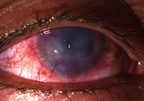 Figure 1 Failed graft after repeat penetrating keratoplasties. The patient complained of a significant decrease in vision, redness, grittiness, and pain.