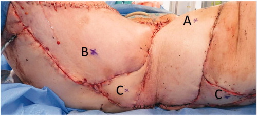 Figure 4. Patient disposed in lithotomy position. A is marked the perforator for the ALT-vastus lateralis, B is marked one of the perforators for the graclis V-Y advancement flap and C are marked the perforators of the two free style perforator flaps.