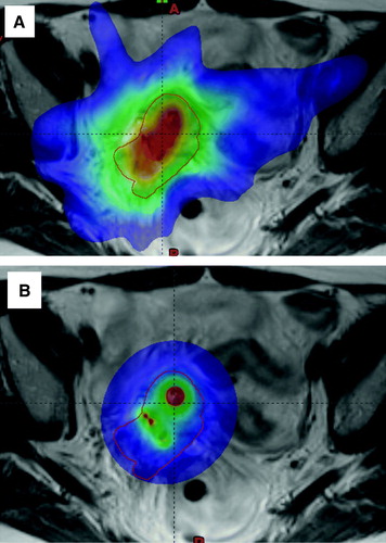 Figure 5.  The coloured area is the volume receiving more than 60Gy EQD2 when using A) IMRT boost, B) IC/IS-BT boost.