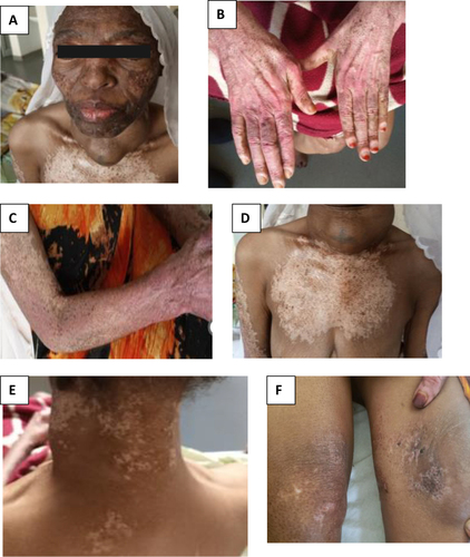 Figure 1 Skin manifestation dermatomyositis in thyroid cancer patient at University of Gondar Hospital during admission. (A) skin manifestation on face (heliotrope rash), (B) Gutron’s papule, (C) skin manifestation on hand, (D) V-sign, (E) shawl’s sign, (F) holster sign.