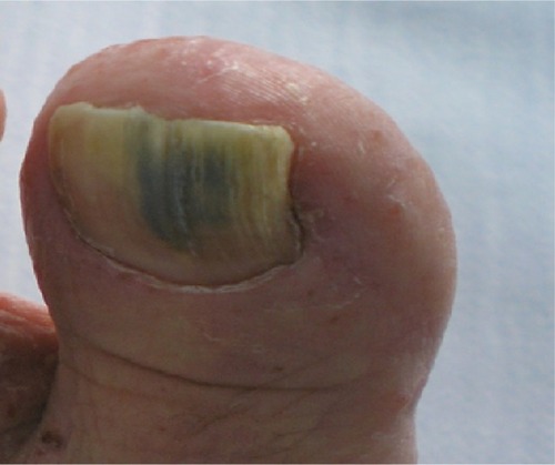Figure 1 Green coloration of the toe nail.
