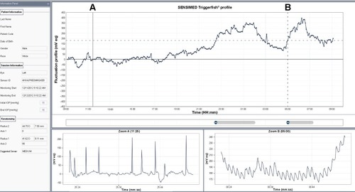 Figure 3 Registration signal over 24 hours (expressed in mV eq output of the sensor), with a close-up during the day (zoom A) and night (zoom B). Reproduced with permission from Sensimed AG © 2014.