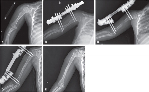 Figure 1. A. Case no 4. A 12-year-old girl with achondroplasia showing shortened right humerus.B. Osteotomy and monolateral fixator application for gradual lengthening of shortened humerus.C. Desired length achieved with use of monolateral fixator.D. 7 months after osteotomy, full consolidation of the newly formed callus. The pixel value ratio (PVR) measured at this point was > 1 in all 4 cortices.E. At the final follow up, 2 years after osteotomy.