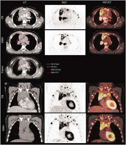 Figure 1. Illustrates the lymphoma volumes on a baseline PET/CT scan in free breathing (FB) and deep-inspiration breath-hold (DIBH) in the axial and coronal plane. The GTVPET represents the FDG avid lymphoma volumes and the GTV represents the anatomical lymphoma volumes including both GTVPET and the PET-negative parts of the lymphoma. The fusion with the contrast-enhanced FB CT scan aids in the contouring of the GTV on the non-enhanced DIBH CT scan. In DIBH, the heart and the large vessels used for the fusion are displaced caudally, hence, the lymph nodes in the left axilla are situated more cranially and not present on the axial DIBH image. Notice, that the lung volume is larger, the heart is displaced caudally and separated from the lymphoma, and the mediastinum narrower on the DIBH scan.