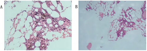 Figure 2 Bone marrow biopsy Immunohistochemistry: CD34 small vessel (+), occasional (+); CD11+ 17 occasional (+); CD61 megakaryocytes (+), sporadic (+); CD3 less (+); CD138 small cluster (+); MPO multiple (+); E-cad multicluster (+).
