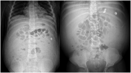 Figure 1. Abdominal plain film of case 1.