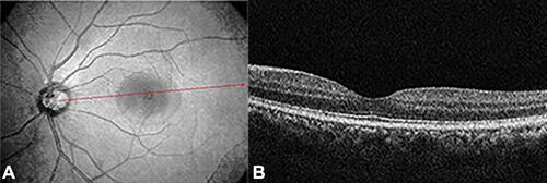 Figure 2 (A) is a red-free photo of the left eye showing attached retina. (B) is a spectral-domain optical coherence tomography (SD-OCT) showing resolved subretinal fluids; a red arrow indicates the location of OCT cut.