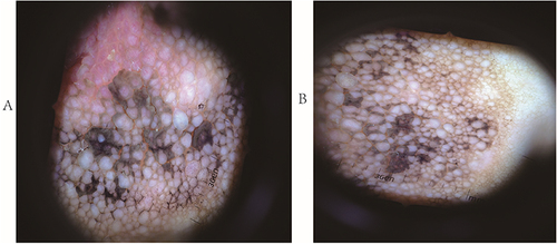 Figure 3 Dermoscopy images of the Bilateral nipples and areolas:color close to skin color, grayish-white cobblestone-like lesions, dark brown patches covered on the lesions, and no blood vessels.(A)right nipple-areola.(B) left nipple-areola.