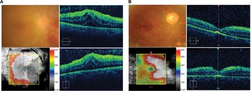 Figure 2 Comparison of fundus and spectral-domain optical coherence tomography images before and after vitrectomy with retinal panretinal photocoagulation.