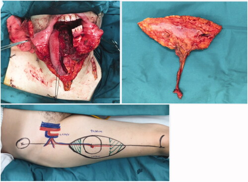 Figure 2. Pre-operative and post-operative outcome of tongue reconstruction utilising the radial forearm free flap.