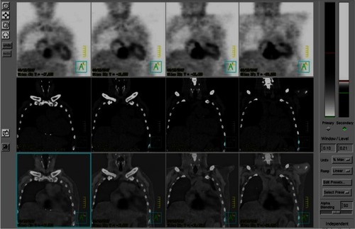 Figure 5 FDG-PET revealed remarkably increased glucose metabolism in the RA, interatrial septum, LA, and in a tumor mass protruding from the posterior aspect of pericardium.