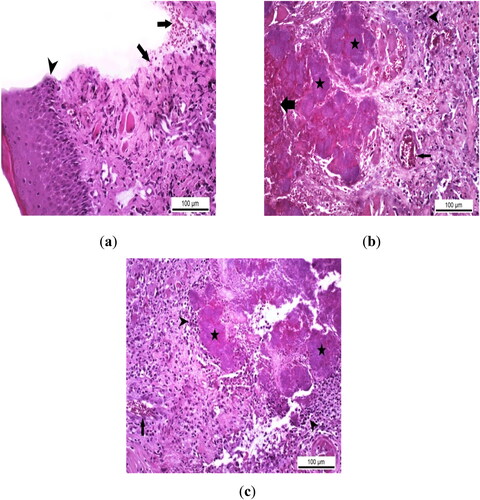 Figure 2. Histopathological analysis of the therapeutic effect of EA in rats with experimental oral mucositis. (a) Routine healing with serofibrinous exudation containing erythrocytes (arrows) and epithelial regeneration (arrowhead) at the incision line in the control group where only experimental oral mucositis was induced, Control Group, oral mucosa, Rat, HE, Scale bar = 100 µm. (b) Severe hemorrhagic and necrotic foci (thick arrow), bacterial colonies (stars), vascular hyperemia in the lamina propria (thin arrow) and inflammatory cell infiltration in the interstitial connective tissue at the infected wound site (arrowhead) in Group I rats with experimental oral mucositis after EA administration for the first 5 days. Group I, oral mucosa, Rat, Scale bar = 100 µm. (c) Bacterial colonies (asterisks) with mononuclear cell infiltration around the necrotic area (arrowheads) and hyperemia in the basal lamina propria (arrow) in Group II rats given EA for 5 days after experimental oral mucositis was induced. Group II, oral mucosa, Rat, HE, Scale bar = 100 µm.