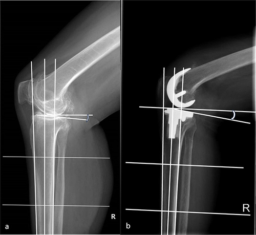 Figure 1 Posterior slope angle before and after surgery; (a) Posterior slope angle before surgery; (b) Posterior slope angle after surgery.