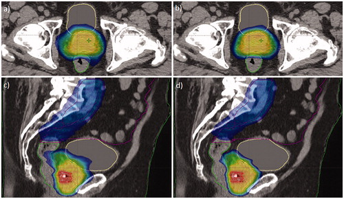 Figure 1. Dose distributions obtained with manual planning (CP; a, c) and the final version of the RapidPlan model (RP_v2; b, d) for the same validation patient. Dose range from 45 Gy (blue) to 73 Gy (red). PTVs are contoured in red, rectum in green, bladder in yellow, and bowel bag in magenta.