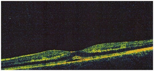Figure 2 Localized left subfoveal neurosensory detachment.