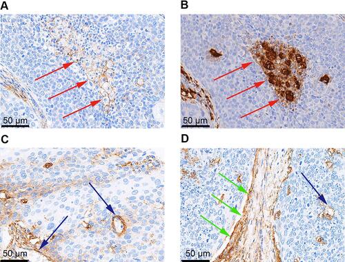 Figure 2 Representative immunohistochemical staining of B7 homolog 3 (B7-H3) in macrophages, endothelial cells, and stromal fibroblasts. B7-H3 expression in (A) macrophages (red arrowheads) and (B) corresponding CD68+ macrophages (red arrowheads); (C) endothelial cells (blue arrowheads); (D) stromal fibroblasts (green arrowheads) and endothelial cells (blue arrowhead).