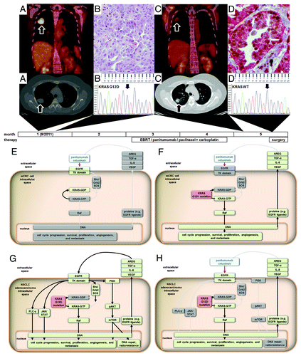 Figure 1. A PET-CT showed avidity in the lung mass (A). Bronchoscopic biopsy with subsequent DNA Sanger sequencing (B) identified a minor clone containing an activating, KRAS G12D mutation. A PET/CT after completion of radiation, chemotherapy, and panitumumab showed a partial response with reduced FDG uptake and residual disease in the mediastinum (C). Ion torrent sequencing revealed that the residual tumor cells harbor the same cancer gene mutations as the pretreatment tumor tissues, with the exception of G12D KRAS mutation being absent (D). In mCRC, which are predominantly adenocarcinomas, panitumumab halts the phosphorylation of KRAS-GDP, preventing activation of the KRAS/RAF/MEK/ERK pathway ([E], blocked pathways grayed out); however, activating mutations cause constitutive activation of the downstream pathway ([F], pathway no longer gray). In NSCLC, even when an activating KRAS mutation is present, all pathways contribute to cell cycle progression, proliferation, angiogenesis, metastasis, and production of EGFR ligands that cause radioresistance ([G], without panitumumab all pathways are active); with panitumumab, although the KRAS pathways may be constitutively activated, the overall number of effectors contributing to cancer cell proliferation is decreased ([H], panitumumab causes inactivation of pathways, now grayed out).