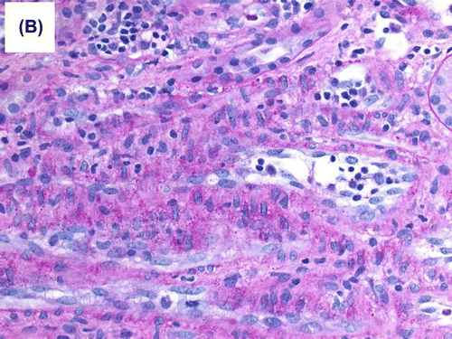 Figure 1b. Moderate interstitial inflammation that involved approximately 30% of renal cortical parenchyma was present, and consisted mainly of lymphocytes and neutrophils.