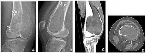 Figure 2 A skeletally mature 16-year-old girl with GCTB in the distal femur. Plain radiographs (A and B) of the knee demonstrate an eccentric expansile osteolytic lesion involving the distal femoral epiphysis and metaphysis. The lesion is well defined with a narrow zone of transition (arrow). CT (C and D) showed focal loss of bone cortex and adjacent soft tissue extension (arrow).