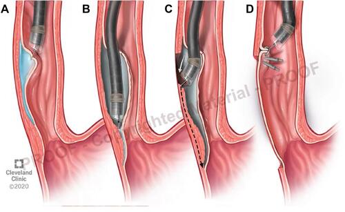 Figure 3 Stepwise illustration of POEM procedure. (A) Mucosal incision and submucosal injection, (B) creation of submucosal tunnel, (C) distal esophageal circular muscle dissection and myotomy, and (D) closure of mucosal incision using endoscopic clips.