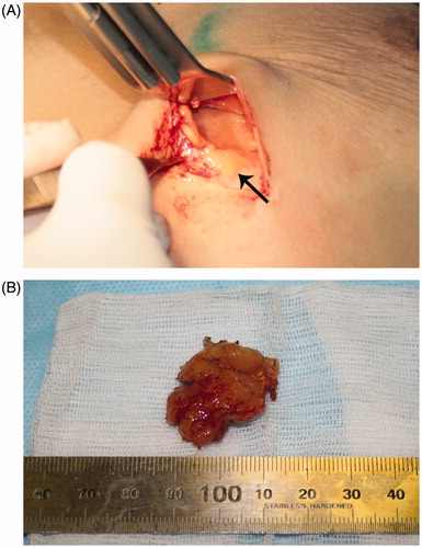 Figure 4. Surgical findings. (A) Remnant xanthoma tissue was identified as 2 × 2 cm yellowish neoplasm in the lower part of the left breast. (B) Surgically removed specimen of xanthoma.