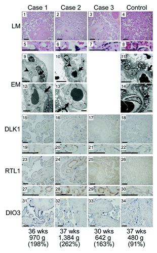 Figure 5. Histological examinations. LM, light microscopic examinations; EM, electron microscopic examinations; DLK1, RTL1 and DIO3, immunohistochemical examinations for the corresponding proteins. The arrows and arrowheads in the EM findings indicate endothelial cells and pericytes, respectively. Scale bars represent 100 μm for 1–4, 15–18, 23–26 and 31–34, 50 μm for 5–8, 19–22 and 27–30, 5 μm for 9–11 and 2 μm for 12–14. Gestational age, placental weight, and % placental weight assessed by the gestational age-matched Japanese references for placental weightCitation4,Citation22are described.