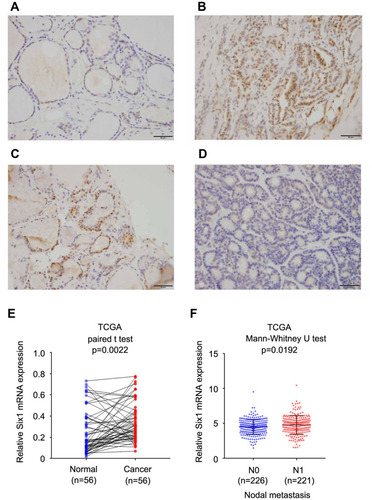 Figure 1 Expression Six1 in thyroid cancer tissues. (A) Negative/weak staining of Six1 in normal thyroid tissues. (B) Positive nuclear Six1 expression in a case of papillary thyroid cancer. (C) Positive nuclear Six1 staining in a case of follicular thyroid cancer. (D) Negative staining a case of follicular thyroid cancer. (E) TCGA data showed that Six1 mRNA was elevated in thyroid cancers compared with normal tissue (paired t test, p=0.0022). (F) TCGA data showed Six1 mRNA was higher in cancers with positive nodal metastasis (Mann–Whitney U-test, p=0.0192). Bar indicates 50uM.