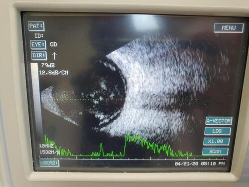 Figure 2 B-scan ultrasonography of the eye for the first case one day post-operatively showing vitreous hemorrhage and complete retinal detachment.