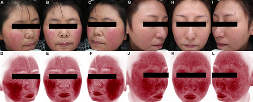 Figure 1 Typical clinical manifestations of facial erythema distribution in patients with rosacea. Peripheral pattern: facial images captured using the VISIA® system with white light (A–C) and red area images processed by RBX technology (D–F). Centrofacial pattern: facial images captured using the VISIA® system with white light (G–I) and red area images processed by RBX technology (J–L).