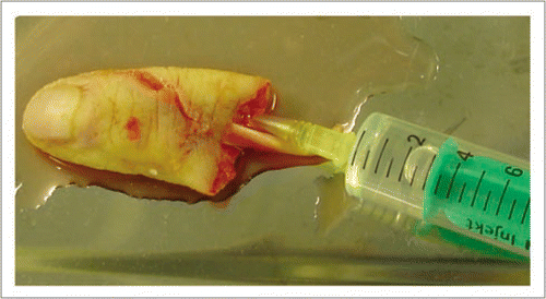 Figure 2 After recovery of the finger, the dominant palmar collateral artery was catheterized and perfused abundantly with Custodiol® solution until flow through from the vein was clear.