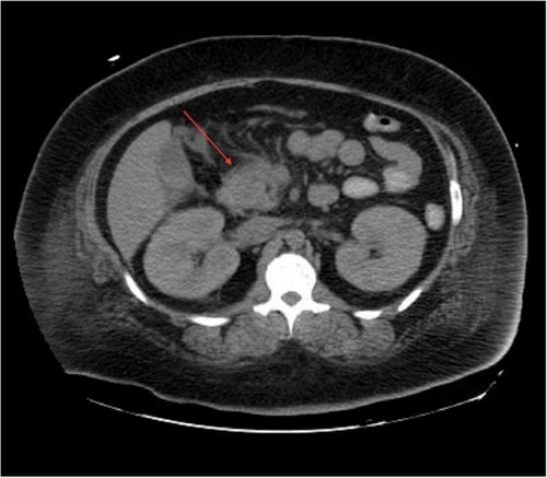 Figure 1 Abdominal computerized tomography scan revealing acute pancreatitis (red arrow).