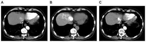 Figure 2 Hepatocellular carcinoma (diameter, 32 mm) at hepatic segment II in a 78-year-old man with hepatitis C who underwent chemoembolization using miriplatin. (A) Arterial phase image from dynamic contrast-enhanced computed tomography (CT) before chemoembolization delineates a well-enhanced nodular lesion located near the inferior vena cava (arrow). (B) Unenhanced CT image obtained 7 days after chemoembolization of arterial segment II + VI shows complete and dense accumulation of iodized oil within the entire lesion. (C) Arterial phase image from contrast-enhanced CT 22 weeks after chemoembolization demonstrated that the accumulated iodized oil has partially disappeared in the ventral side of the tumor where local tumor recurrence emerged (arrow).