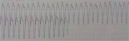 Figure 2 Seventy year-old woman, known hypertensive with an episode of ventricular tachycardia during 24-hour Holter ECG.