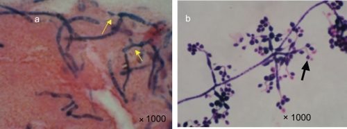 Figure 2 a Gram staining of the corneal scraping smear shows septate hyphae. Arrows indicate budding. b Beauveria bassiana cultured on a slide. Note the zig-zag rachis (arrowheads) and oval conidia.