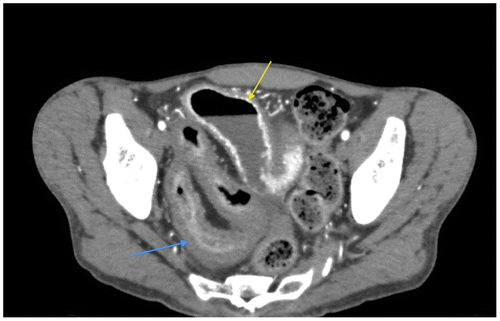 Figure 1d: Axial CT in a known patient with Crohn’s disease showing mural hyper-enhancement (yellow arrow) and mural thickening (blue arrow)