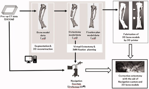 Figure 3. The schematic diagram showing the overall workflow. The processes for osteotomy planning shown in the gray box were performed by a 3D modeling workstation. IMN: Intramenudally nail.