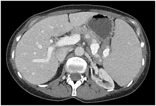 Figure 1. The patient’s abdominal CT scan demonstrates massive splenomegaly with adjacent abdominal lymphadenopathy.
