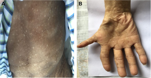 Figure 3 (A and B) Physical examination showed generalized hyperpigmentation of the skin and a thumb malformation of the right hand, accompanied by a few café au lait spots, particularly of the upper extremities.