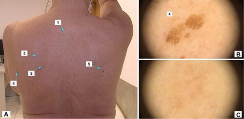 Figure 9 Case 3. (A) Macro-photo of 5 selected seborrheic keratoses lesions for HIFU treatment. (B) Dermoscope picture of lesion number 4 before HIFU. (C) Dermoscope picture of lesion number 4 at the control visit 5 weeks after treatment.