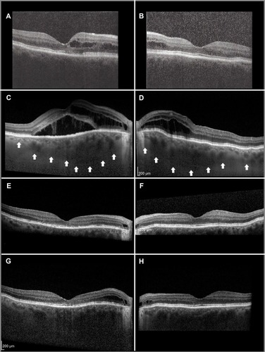 Figure 1 Serial OCT scans, right eye in left column and left eye in right column.