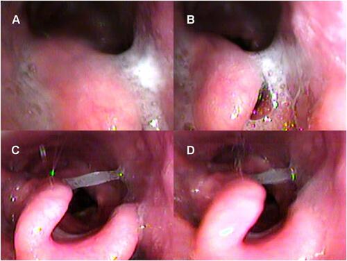 Figure 9 Drug-induced sleep endoscopy results at the epiglottis level: head rotation to the left. Head rotation without intermittent negative airway pressure (iNAP) therapy during (A) inspiration and (B) expiration. Head rotation with iNAP therapy during (C) inspiration and (D) expiration.