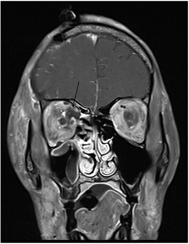 Figure 3 Coronal T1 post contrast shows right intra-orbital collection (arrows).