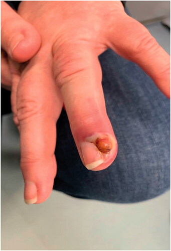 Figure 1. Clinical image of the lesion present on the left ring finger.